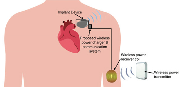 Implantable-medical-device-communicates-with-the-external-world